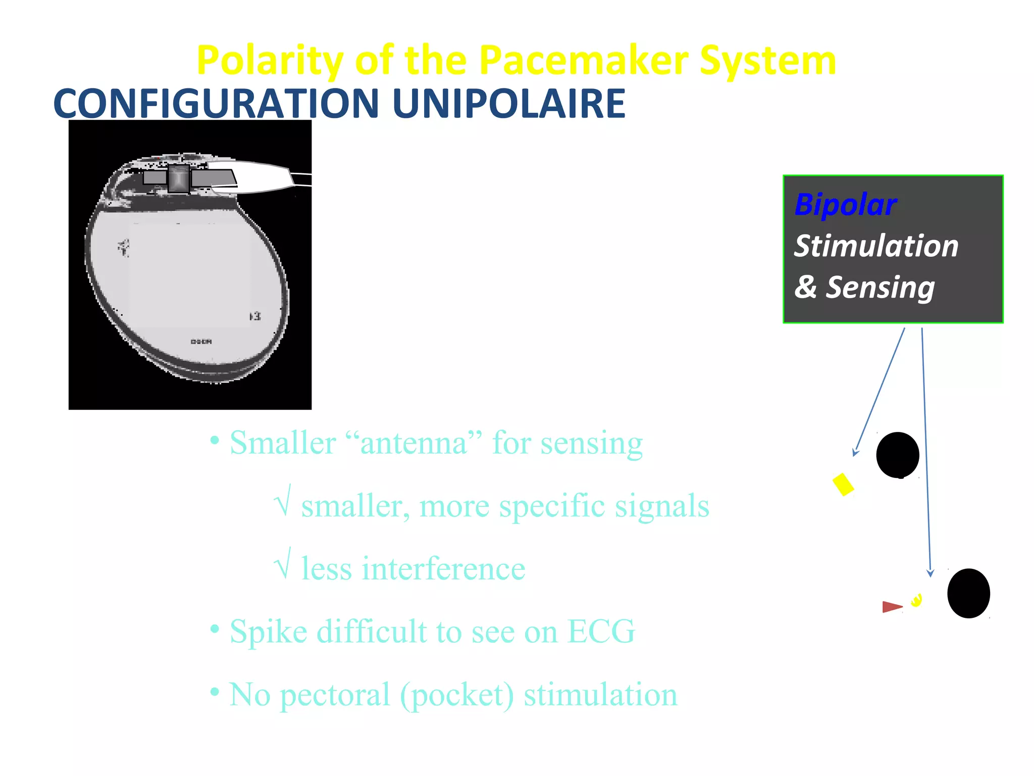 CONFIGURATION UNIPOLAIRE
-
Polarity of the Pacemaker System
Bipolar
Stimulation
& Sensing
+
• Smaller “antenna” for sensing
√ smaller, more specific signals
√ less interference
• Spike difficult to see on ECG
• No pectoral (pocket) stimulation
 