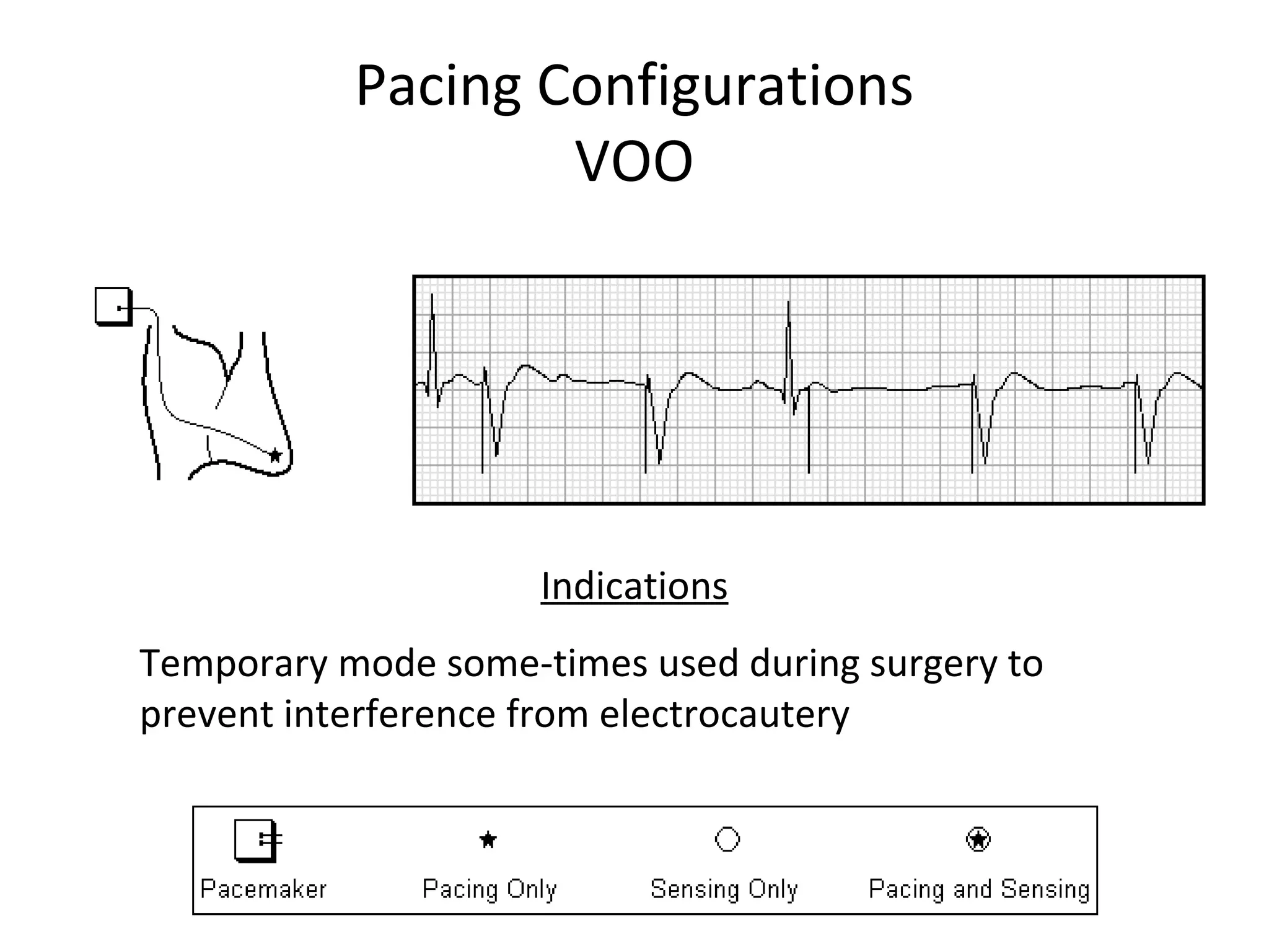 Pacing Configurations
VOO
Indications
Temporary mode some-times used during surgery to
prevent interference from electrocautery
 