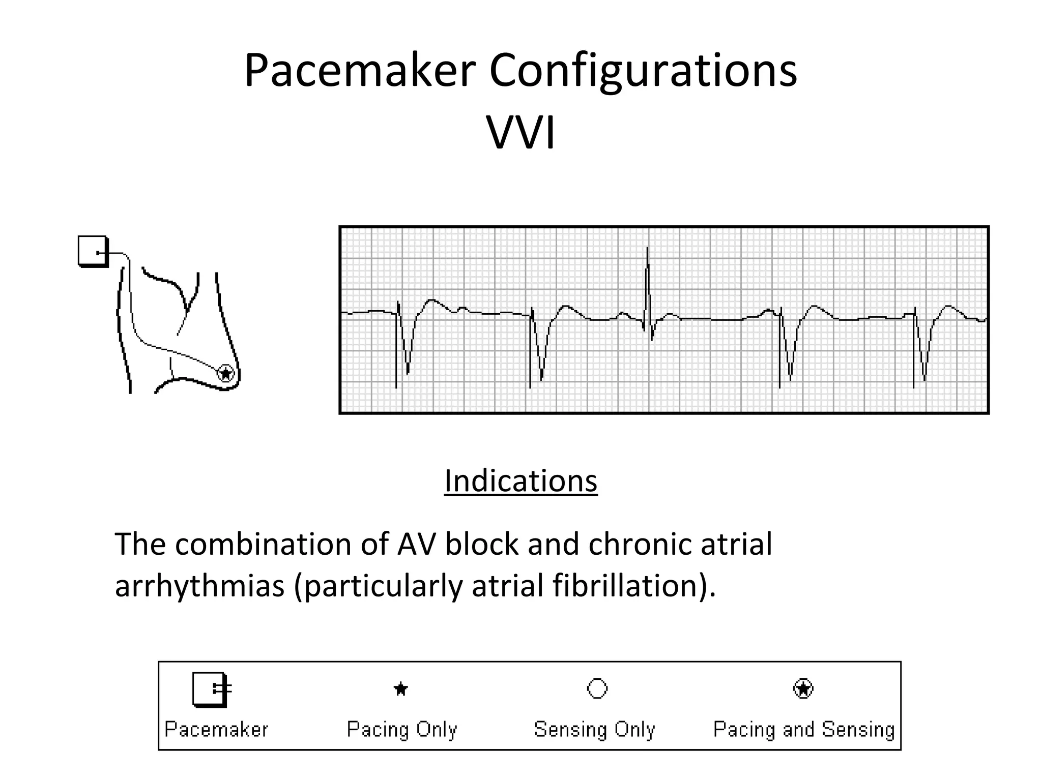 Pacemaker Configurations
VVI
Indications
The combination of AV block and chronic atrial
arrhythmias (particularly atrial fibrillation).
 