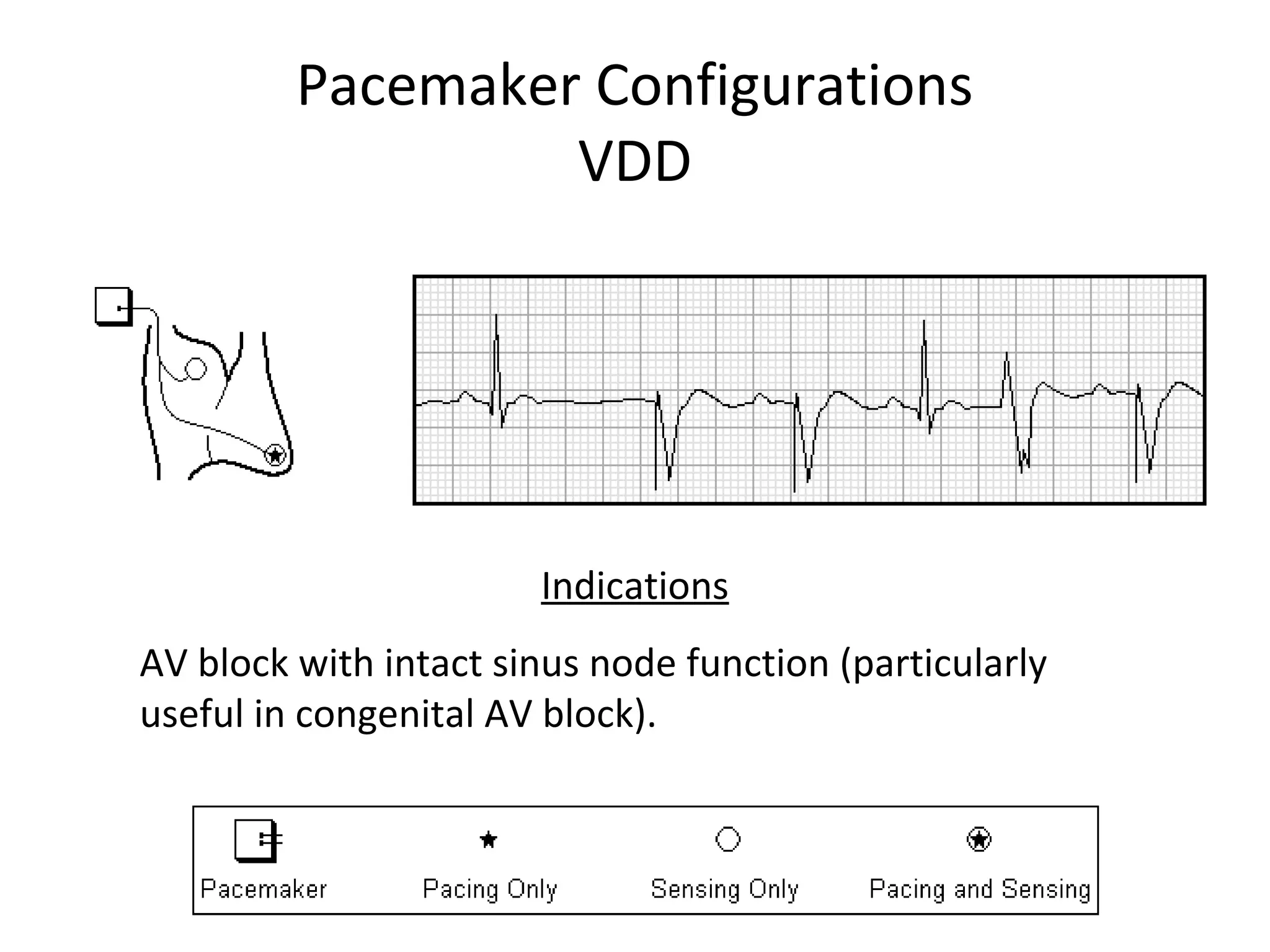 Pacemaker Configurations
VDD
Indications
AV block with intact sinus node function (particularly
useful in congenital AV block).
 