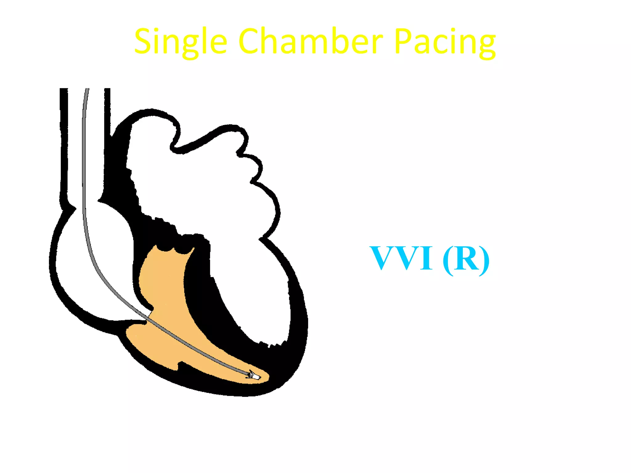 Single Chamber Pacing
VVI (R)
 