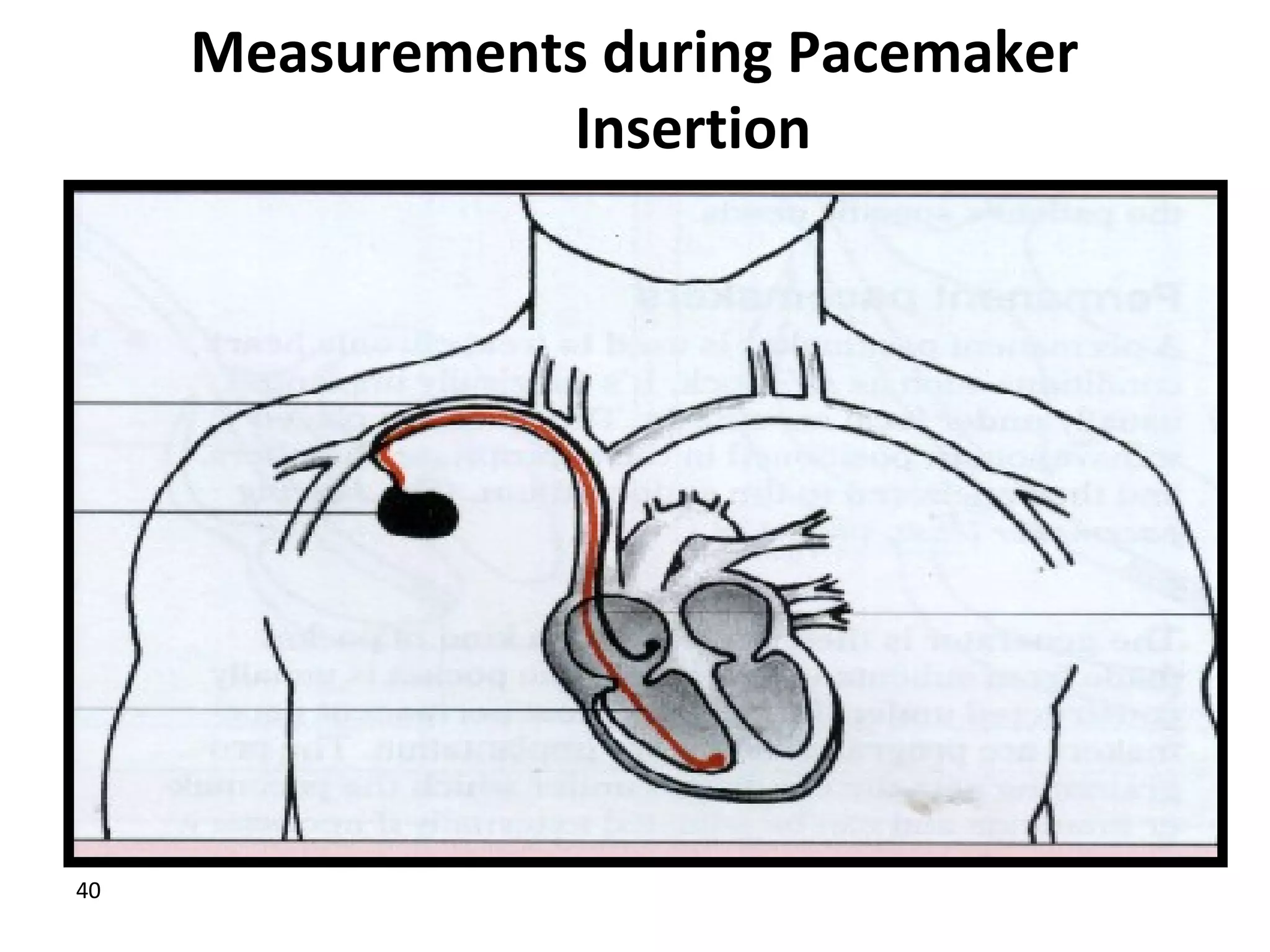40
Measurements during Pacemaker
Insertion
 