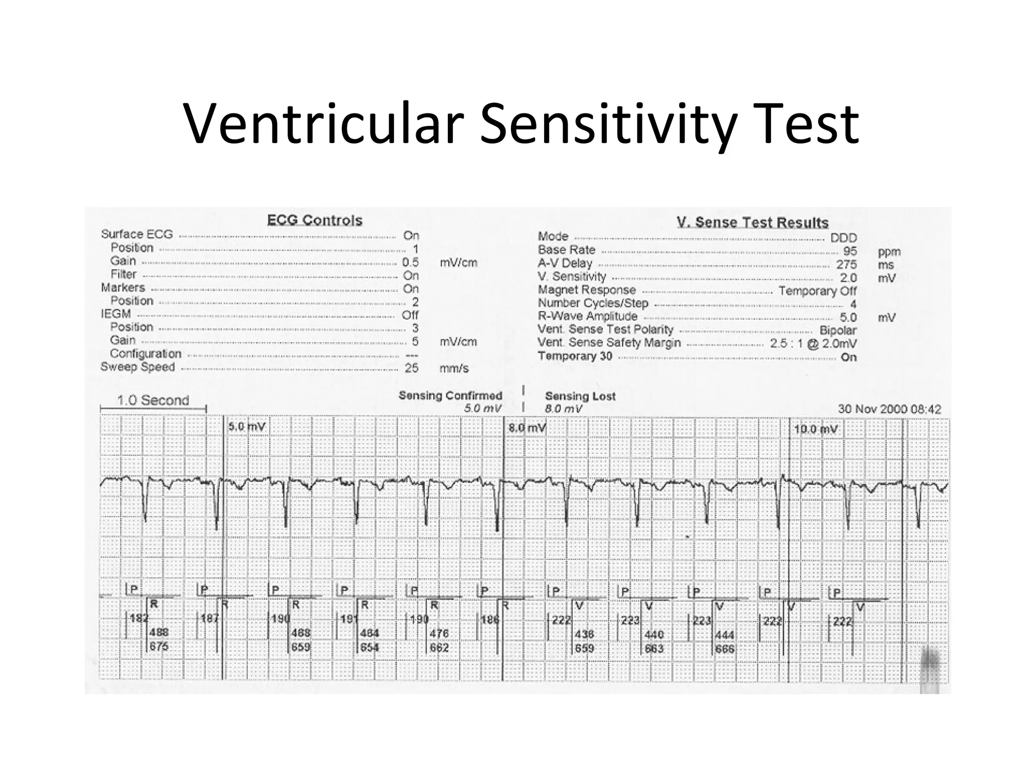 Ventricular Sensitivity Test
 