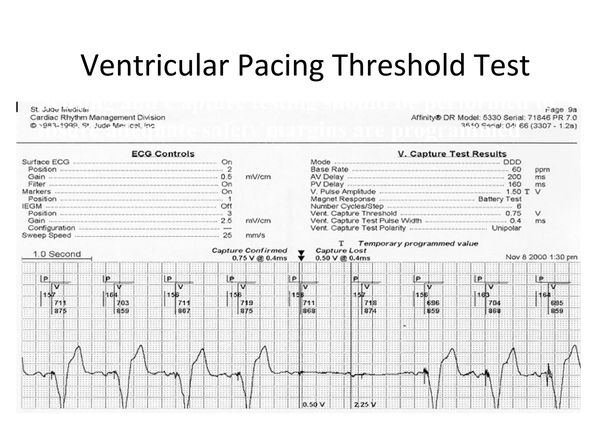 Ventricular Pacing Threshold Test
Sensing and Capture testing should be performed to
insure adequate safety margins are programmed
 