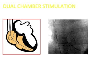 Cardiac pace makerspart 1 | PPT