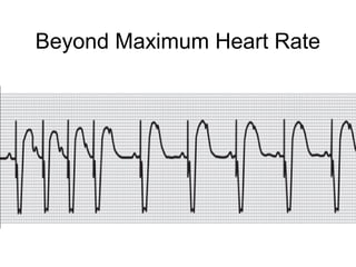 Heart Rate Mschart Pacemaker Cardiac pacemakers part ii | PPT