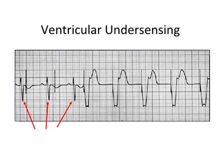 non-sensed R-waves
Ventricular Undersensing
 