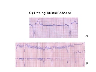 C) Pacing Stimuli Absent
A
B
 