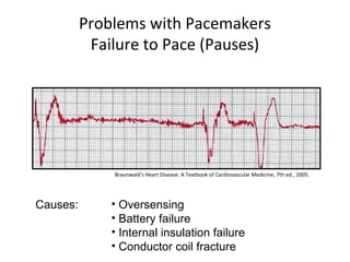 Problems with Pacemakers
Failure to Pace (Pauses)
Causes: • Oversensing
• Battery failure
• Internal insulation failure
• Conductor coil fracture
Braunwald's Heart Disease: A Textbook of Cardiovascular Medicine, 7th ed., 2005.
 
