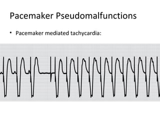 Pacemaker Pseudomalfunctions
• Pacemaker mediated tachycardia:
 
