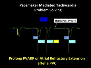 AVD
PVARP AREPVARP
AVD
PVARP
Retrograde P wavePVC
Prolong PVARP or Atrial Refractory Extension
after a PVC
Pacemaker Mediated Tachycardia
Problem Solving
 