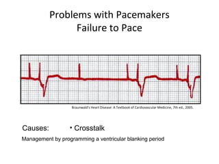 Problems with Pacemakers
Failure to Pace
Causes: • Crosstalk
Braunwald's Heart Disease: A Textbook of Cardiovascular Medicine, 7th ed., 2005.
Management by programming a ventricular blanking period
 