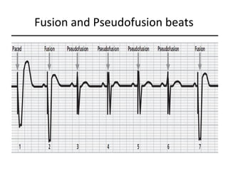 Fusion and Pseudofusion beats
 