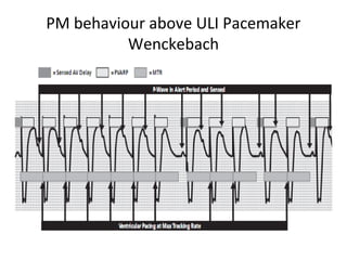 PM behaviour above ULI Pacemaker
Wenckebach
 