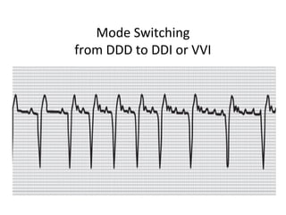 Mode Switching
from DDD to DDI or VVI
 