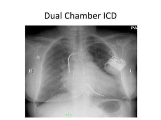 Dual Chamber ICD
 