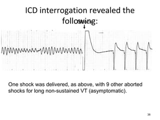 38
Shock
ICD interrogation revealed the
following:
One shock was delivered, as above, with 9 other aborted
shocks for long non-sustained VT (asymptomatic).
 