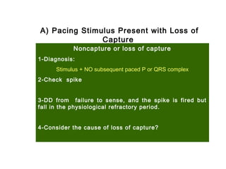 A) Pacing Stimulus Present with Loss of
Capture
Noncapture or loss of capture
1-Diagnosis:
Stimulus + NO subsequent paced P or QRS complex
2-Check spike
3-DD from failure to sense, and the spike is fired but
fall in the physiological refractory period.
4-Consider the cause of loss of capture?
 