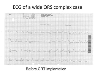 ECG of a wide QRS complex case
Before CRT implantation
 