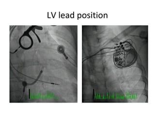 LV lead position
 