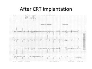 After CRT implantation
 