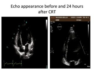 Echo appearance before and 24 hours
after CRT
 