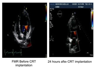 FMR Before CRT
implantation
24 hours after CRT implantation
 