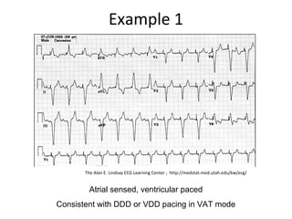 Example 1
Atrial sensed, ventricular paced
Consistent with DDD or VDD pacing in VAT mode
The Alan E. Lindsay ECG Learning Center ; http://medstat.med.utah.edu/kw/ecg/
 