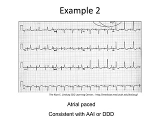 Example 2
Atrial paced
Consistent with AAI or DDD
The Alan E. Lindsay ECG Learning Center ; http://medstat.med.utah.edu/kw/ecg/
 