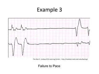 Example 3
Failure to Pace
The Alan E. Lindsay ECG Learning Center ; http://medstat.med.utah.edu/kw/ecg/
 