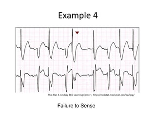 Example 4
Failure to Sense
The Alan E. Lindsay ECG Learning Center ; http://medstat.med.utah.edu/kw/ecg/
 