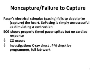 5
Noncapture/Failure to Capture
Pacer’s electrical stimulus (pacing) fails to depolarize 
(capture) the heart. SoPacing is simply unsuccessful 
at stimulating a contraction
ECG shows properly timed pacer spikes but no cardiac 
response
↓ CO occurs
↓ Investigation: X-ray chest , PM check by 
programmer, full lab work.
 