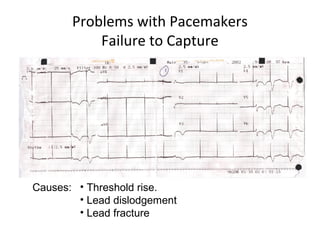 Problems with Pacemakers
Failure to Capture
Causes: • Threshold rise.
• Lead dislodgement
• Lead fracture
 