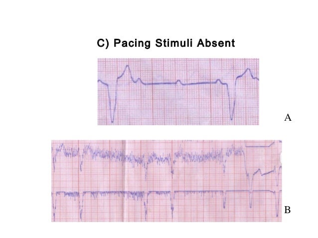 Cardiac pacemakerspart iii