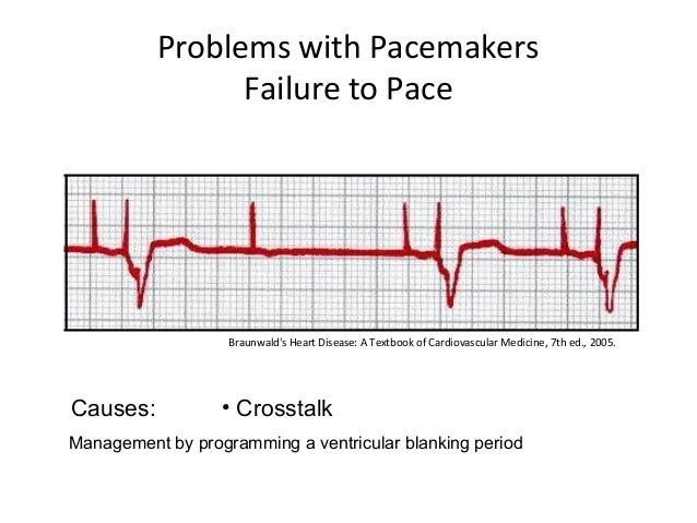 Pacemaker failure to capture - indeyareX