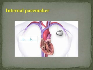 Cardiac pacemaker | PPTX