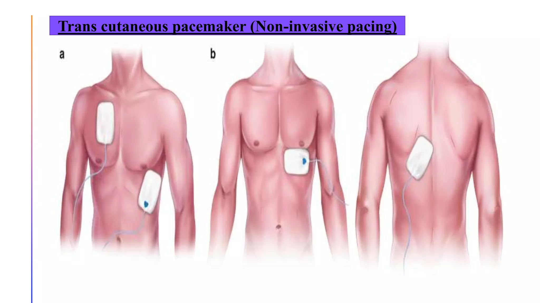 Trans cutaneous pacemaker (Non-invasive pacing)
 