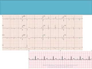Cardiac pacemaker | PDF