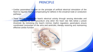 CARDIAC PACEMAKERS_by biotech students.pptx