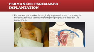 Placemaker Types Cardiac Pacemaker , Types of Pacemaker and its Usages | PPTX