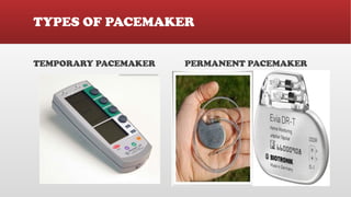Cardiac Pacemaker , Types of Pacemaker and its Usages | PPTX