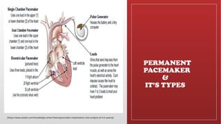 Placemaker Types Cardiac Pacemaker , Types of Pacemaker and its Usages | PPTX