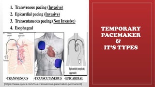 Placemaker Types Cardiac Pacemaker , Types of Pacemaker and its Usages | PPTX