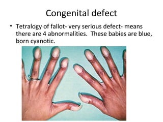Congenital defect
• Tetralogy of fallot- very serious defect- means
there are 4 abnormalities. These babies are blue,
born cyanotic.

 