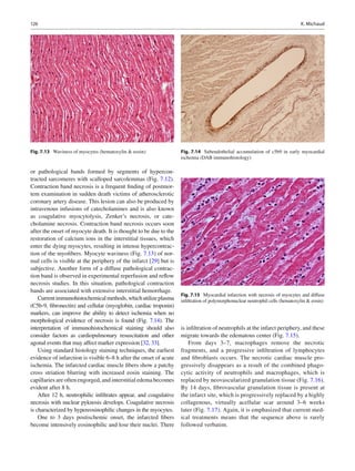 126 K. Michaud
or pathological bands formed by segments of hypercon-
tracted sarcomeres with scalloped sarcolemmas (Fig. 7.12).
Contraction band necrosis is a frequent ﬁnding of postmor-
tem examination in sudden death victims of atherosclerotic
coronary artery disease. This lesion can also be produced by
intravenous infusions of catecholamines and is also known
as coagulative myocytolysis, Zenker’s necrosis, or cate-
cholamine necrosis. Contraction band necrosis occurs soon
after the onset of myocyte death. It is thought to be due to the
restoration of calcium ions in the interstitial tissues, which
enter the dying myocytes, resulting in intense hypercontrac-
tion of the myoﬁbers. Myocyte waviness (Fig. 7.13) of nor-
mal cells is visible at the periphery of the infarct [29] but is
subjective. Another form of a diffuse pathological contrac-
tion band is observed in experimental reperfusion and reﬂow
necrosis studies. In this situation, pathological contraction
bands are associated with extensive interstitial hemorrhage.
Currentimmunohistochemicalmethods,whichutilizeplasma
(C5b-9, ﬁbronectin) and cellular (myoglobin, cardiac troponin)
markers, can improve the ability to detect ischemia when no
morphological evidence of necrosis is found (Fig. 7.14). The
interpretation of immunohistochemical staining should also
consider factors as cardiopulmonary resuscitation and other
agonal events that may affect marker expression [32, 33].
Using standard histology staining techniques, the earliest
evidence of infarction is visible 6–8 h after the onset of acute
ischemia. The infarcted cardiac muscle ﬁbers show a patchy
cross striation blurring with increased eosin staining. The
capillaries are often engorged, and interstitial edema becomes
evident after 8 h.
After 12 h, neutrophilic inﬁltrates appear, and coagulative
necrosis with nuclear pyknosis develops. Coagulative necrosis
is characterized by hypereosinophilic changes in the myocytes.
One to 3 days postischemic onset, the infarcted ﬁbers
become intensively eosinophilic and lose their nuclei. There
is inﬁltration of neutrophils at the infarct periphery, and these
migrate towards the edematous center (Fig. 7.15).
From days 3–7, macrophages remove the necrotic
fragments, and a progressive inﬁltration of lymphocytes
and ﬁbroblasts occurs. The necrotic cardiac muscle pro-
gressively disappears as a result of the combined phago-
cytic activity of neutrophils and macrophages, which is
replaced by neovascularized granulation tissue (Fig. 7.16).
By 14 days, ﬁbrovascular granulation tissue is present at
the infarct site, which is progressively replaced by a highly
collagenous, virtually acellular scar around 3–6 weeks
later (Fig. 7.17). Again, it is emphasized that current med-
ical treatments means that the sequence above is rarely
followed verbatim.
Fig. 7.13 Waviness of myocytes (hematoxylin & eosin) Fig. 7.14 Subendothelial accumulation of c5b9 in early myocardial
ischemia (DAB immunohistology)
Fig. 7.15 Myocardial infarction with necrosis of myocytes and diffuse
inﬁltration of polymorphonuclear neutrophil cells (hematoxylin & eosin)
 