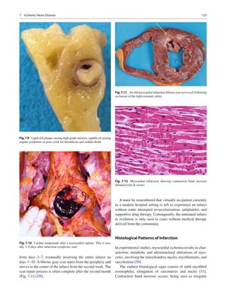 1257 Ischemic Heart Disease
from days 3–7, eventually involving the entire infarct on
days 7–10. A ﬁbrous gray scar starts from the periphery and
moves to the center of the infarct from the second week. The
scar repair process is often complete after the second month
(Fig. 7.11) [29].
It must be remembered that virtually no patient currently
in a modern hospital setting is left to experience an infarct
without some attempted revascularization, antiplatelet, and
supportive drug therapy. Consequently, the untreated infarct
in evolution is only seen in cases without medical therapy
derived from the community.
Histological Patterns of Infarction
In experimental studies, myocardial ischemia results in char-
acteristic metabolic and ultrastructural alterations of myo-
cytes, involving the mitochondria, nuclei, myoﬁlaments, and
sarcolemma [30].
The earliest histological signs consist of mild myoﬁbril
eosinophilia, elongation of sarcomeres and nuclei [31].
Contraction band necrosis occurs, being seen as irregular
Fig.7.9 Lipid-rich plaque causing high-grade stenosis, capable of causing
angina symptoms or pose a risk for thrombosis and sudden death
Fig. 7.10 Cardiac tamponade after a myocardial rupture. This is usu-
ally 3–6 days after infarction symptoms start
Fig.7.11 An old myocardial infarction ﬁbrous scar (arrowed) following
occlusion of the right coronary artery
Fig. 7.12 Myocardial infarction showing contraction band necrosis
(hematoxylin & eosin)
 
