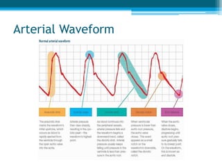 Arterial Waveform
 