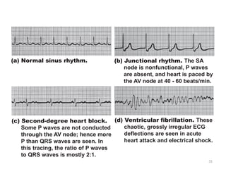 35
(a) Normal sinus rhythm.
(c) Second-degree heart block.
Some P waves are not conducted
through the AV node; hence more
P than QRS waves are seen. In
this tracing, the ratio of P waves
to QRS waves is mostly 2:1.
(d) Ventricular fibrillation. These
chaotic, grossly irregular ECG
deflections are seen in acute
heart attack and electrical shock.
(b) Junctional rhythm. The SA
node is nonfunctional, P waves
are absent, and heart is paced by
the AV node at 40 - 60 beats/min.
 