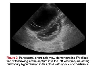 Cardiac_POCUS_Pediatrics Latest Guidelines | PPTX