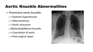 Aortic Shadow Comprehensive Interpretation of Cardiac Shadow on Chest X-Ray | PDF
